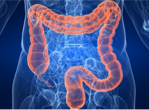 COLON CANCER