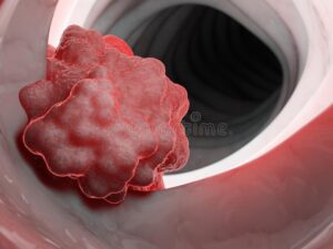 rectal cancer