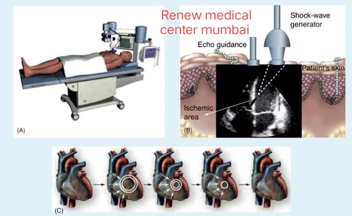 ESMR Cardio Vascular Treatment